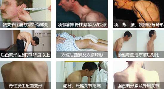 貴陽(yáng)強(qiáng)直醫(yī)院強(qiáng)直性脊柱炎引起脊椎彎曲、關(guān)節(jié)疼痛.jpg
