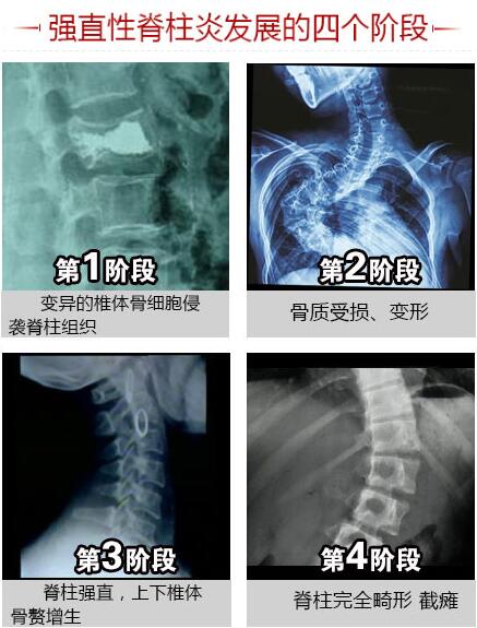 強直性脊柱炎發(fā)展的四個階段.jpg